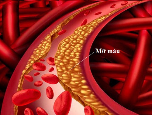 benh mau mo va nhung dieu can biet