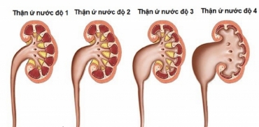 than u nuoc do soi  ly giai nguyen nhan va cach dieu tri