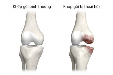 thoai hoa khop va nhung dieu can biet